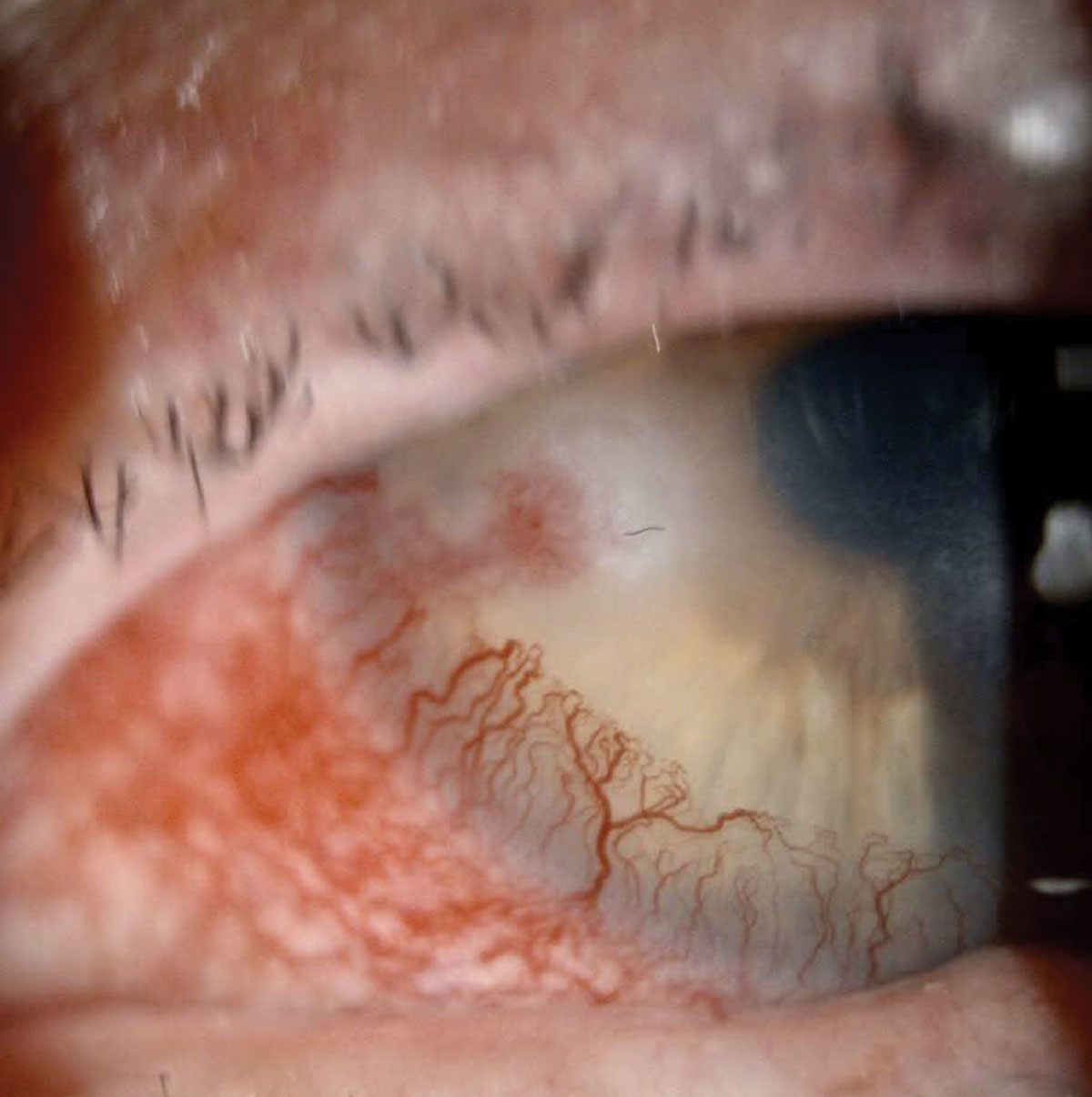 Case 5. Slit lamp exam in this patient showed significant telangiectatic blepharitis, a corneal infiltrate with a leash of superficial neovascularization from the nasal limbus and a smaller-sized epithelial defect overlying the infiltrate.
