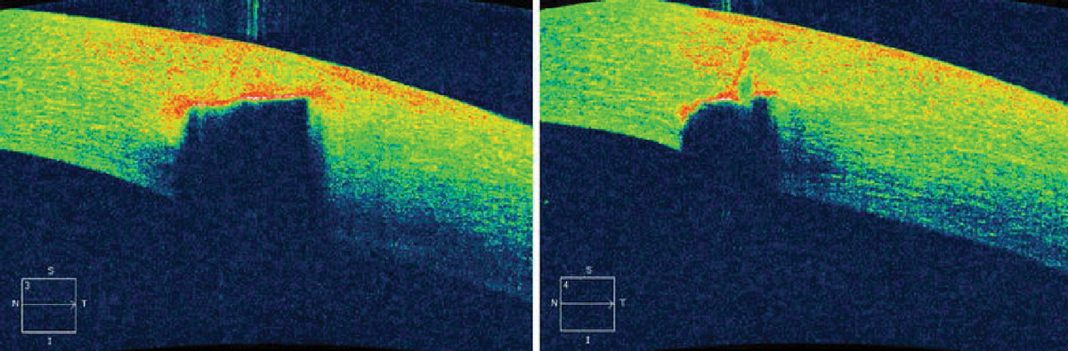 Fig. 2. Preoperative imaging of the patient’s left eye. AS-OCT shows hyper-reflectivity and shadowing due to the corneal foreign body (left). The corneal foreign body did not completely penetrate the cornea (right).