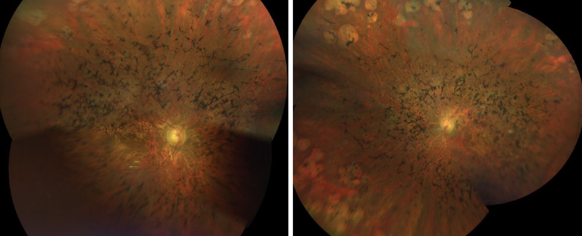 Figs. 1 & 2. Here is a widefield view of the right and left eye of our patient. How do you explain the clinical findings?