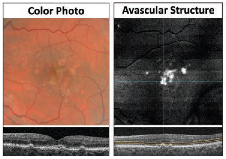 En face OCT imaging can help with the detection of AMD, which was validated in this recent study.