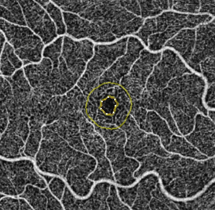 Beware the possibility of dilating drops affecting accurate measurement of the foveal avascular zone.