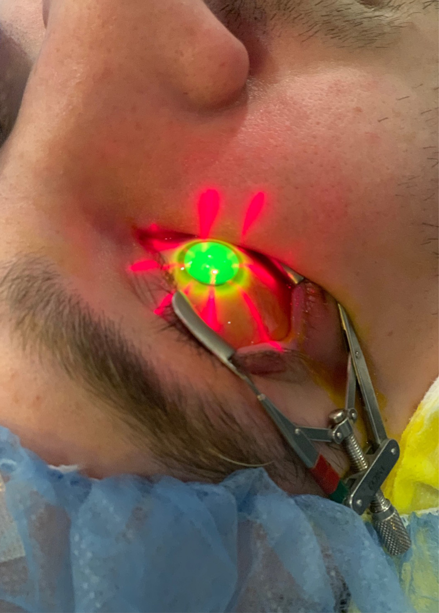 Epi-off corneal crosslinking in a patient with progressive keratoconus. Photo by Alexandra Wiechmann, OD. 