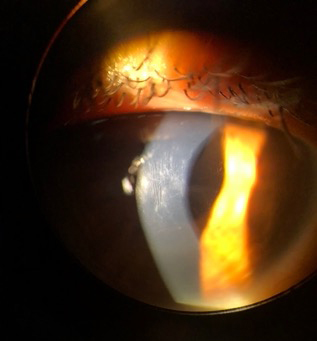 Vogt’s striae in a patient with advanced keratoconus before crosslinking. Photo by Thomas Nettleton, OD.