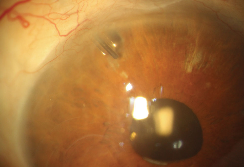 Patients with dry eye or chronic angle closure may be more likely to need GDD revision or removal. 