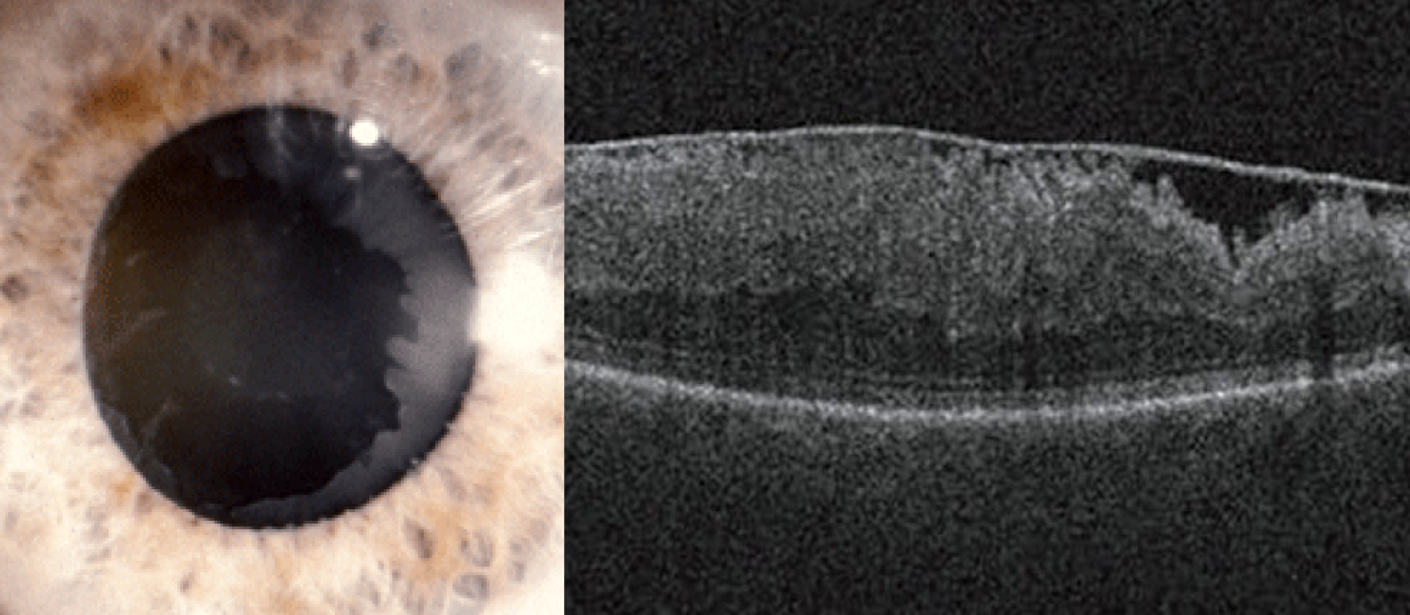 This study linked pseudoexfoliative glaucoma and epiretinal membrane deterioration.