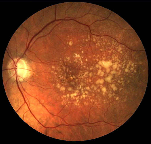 The second eye to be treated in AMD patients was found to have a higher BCVA, likely because the eye was being regularly examined throughout treatment of the first eye.