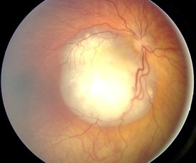 Maternal and paternal age didn't appear to influence bilateral retinoblastoma risk in this study.