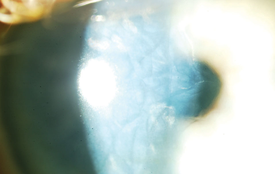Fuchs endothelial corneal dystrophy may affect as many as 7% of adults, a number expected to grow in coming years. 