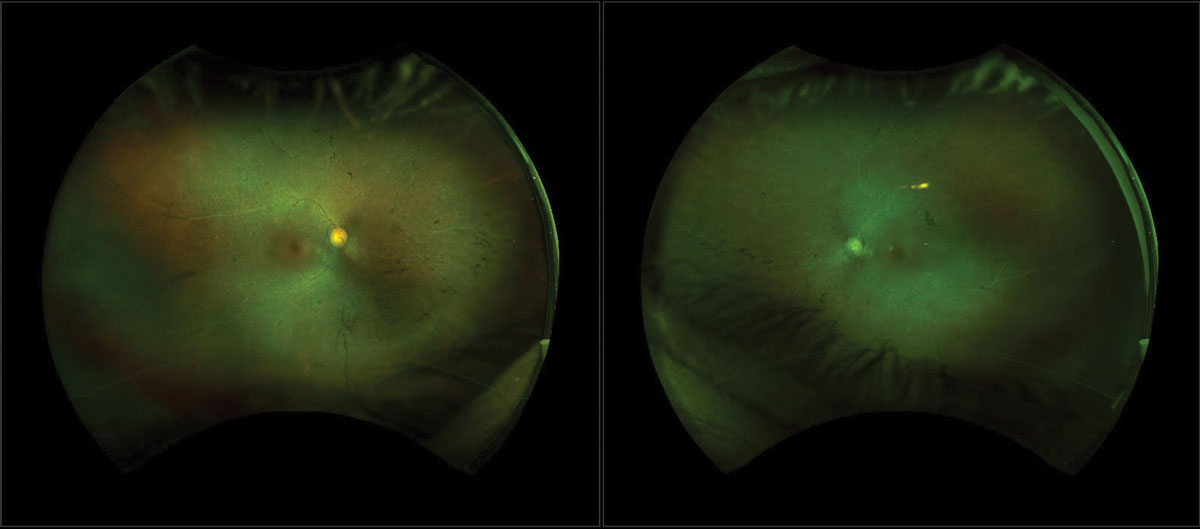 Retinoic acid inhibitors could be able to treat patients with retinitis pigmentosa.
