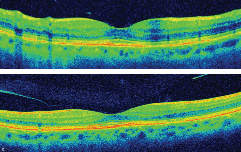 Patients with hydroxychloroquine retinopathy recognized at a mild stage generally stabilize their thickness values within six to 12 months after discontinuing the medication.