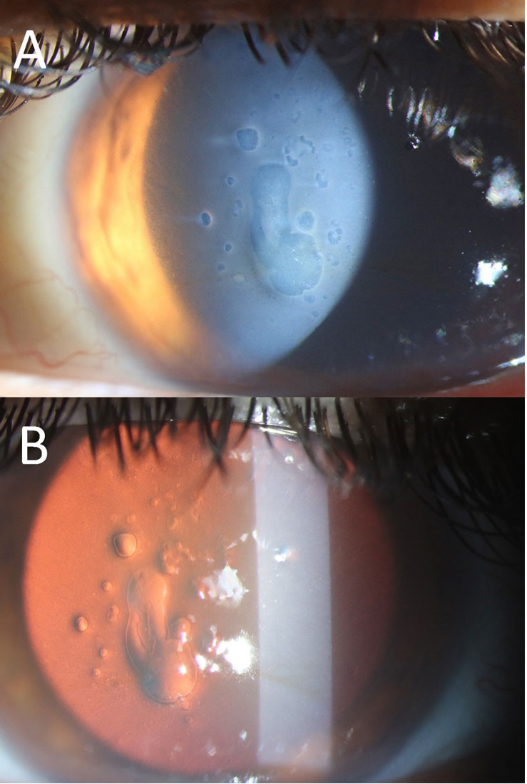 Fig. 1. Slit lamp examination on direct (A) and retro (B) illumination reveals large, scattered epithelial bullae with mild corneal haze. Note the quiet conjunctiva (A).