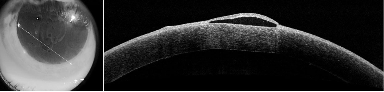 Fig. 2. Anterior segment OCT through the cornea reveals prominent epithelial bullae and minimal stromal thickening. There were no endothelial KPs visible on any OCT images.