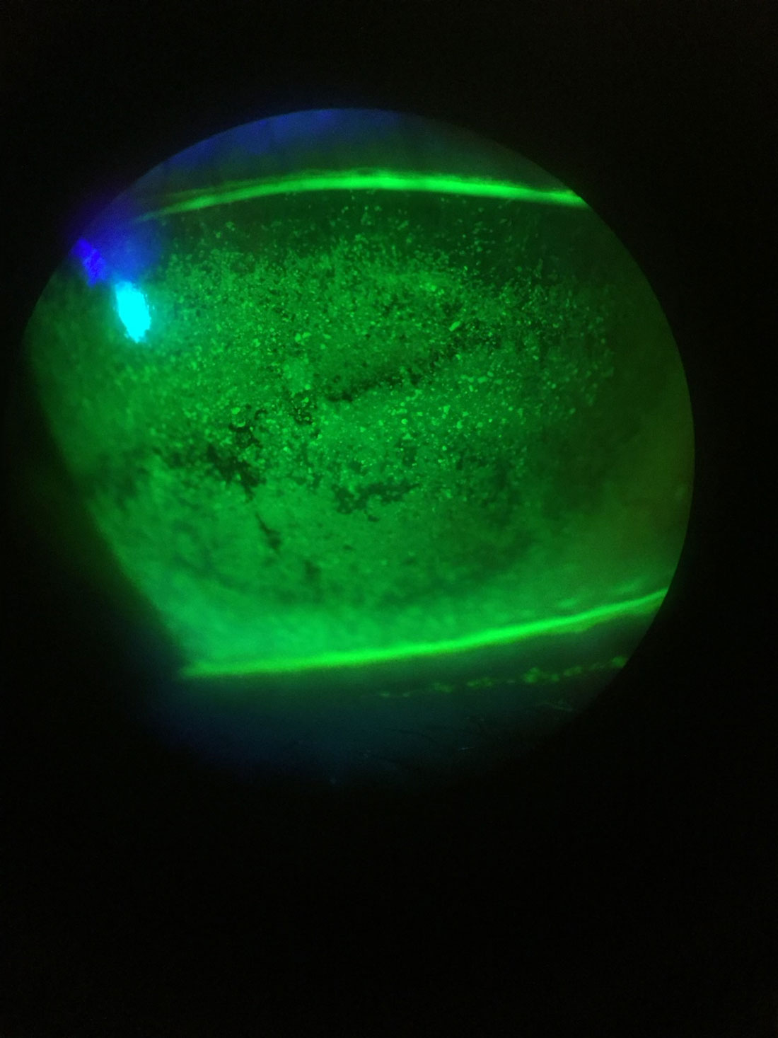 Fig. 1. Slit lamp image of diffuse punctate corneal staining.