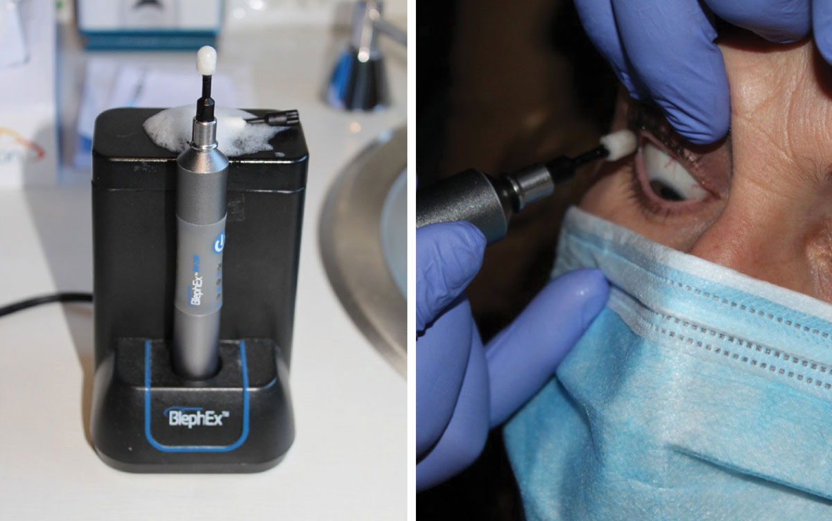 Fig. 4. The BlephEx device or in-office removal of eyelid scurf and bacterial debris, which can cause inflammatory lid disease. The rotating pad buffs away the biofilm and other lid debris to prevent blepharitis.