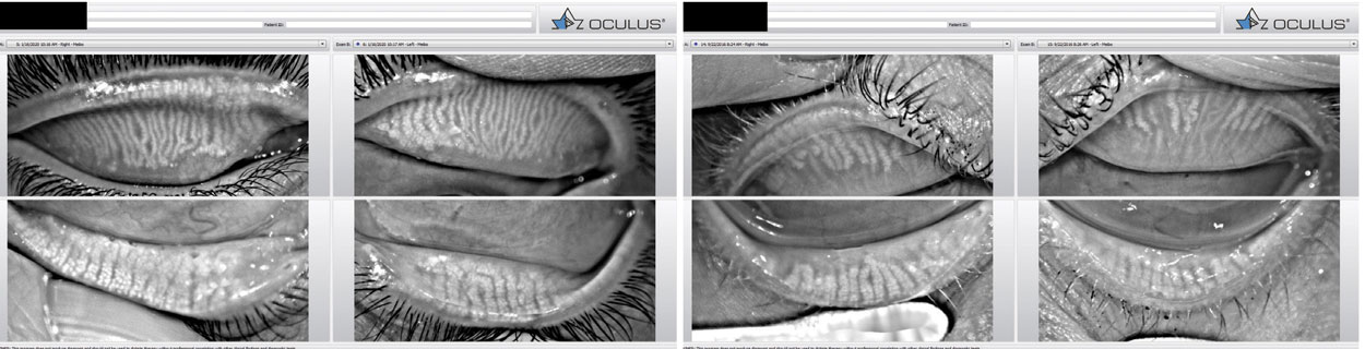 Fig. 7. X-rays of the eyelids of a patient with meibomian gland dysfunction.