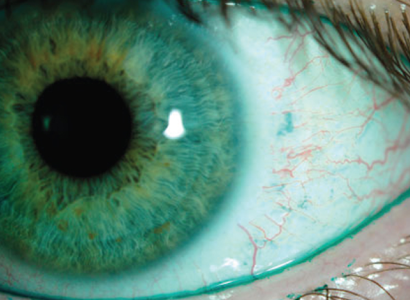 Dry eye surveys can inform you about factors such as frequency and severity of patients’ symptoms, which you wouldn’t know simply by looking at their eyes.