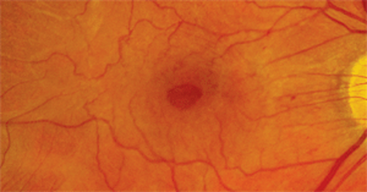 Tractional forces from epiretinal membrane or vitreous adhesion were identified in patients in any lamellar macular hole stage. 