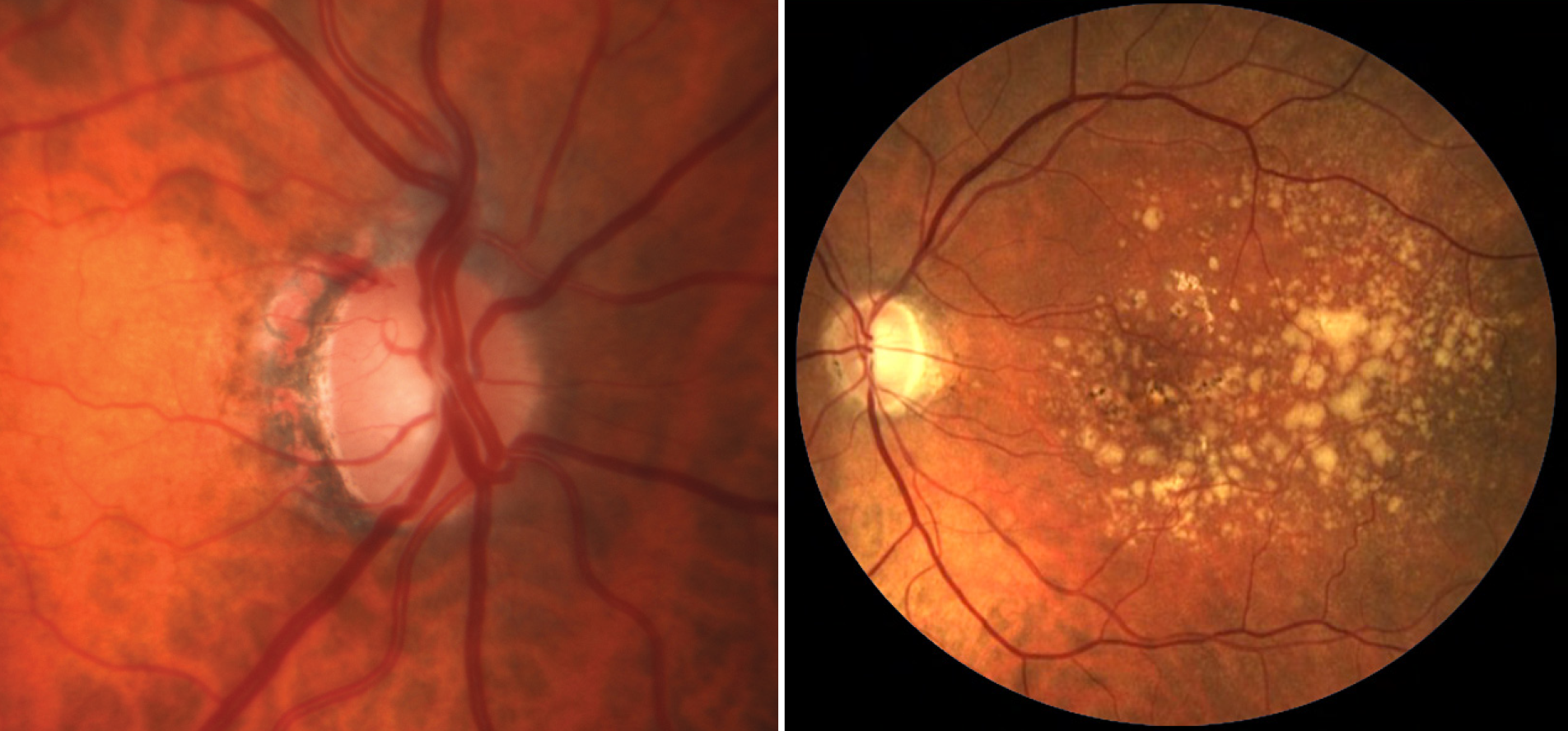 Diabetes medications such as metformin and insulin were associated with a lower risk of open-angle glaucoma or AMD.