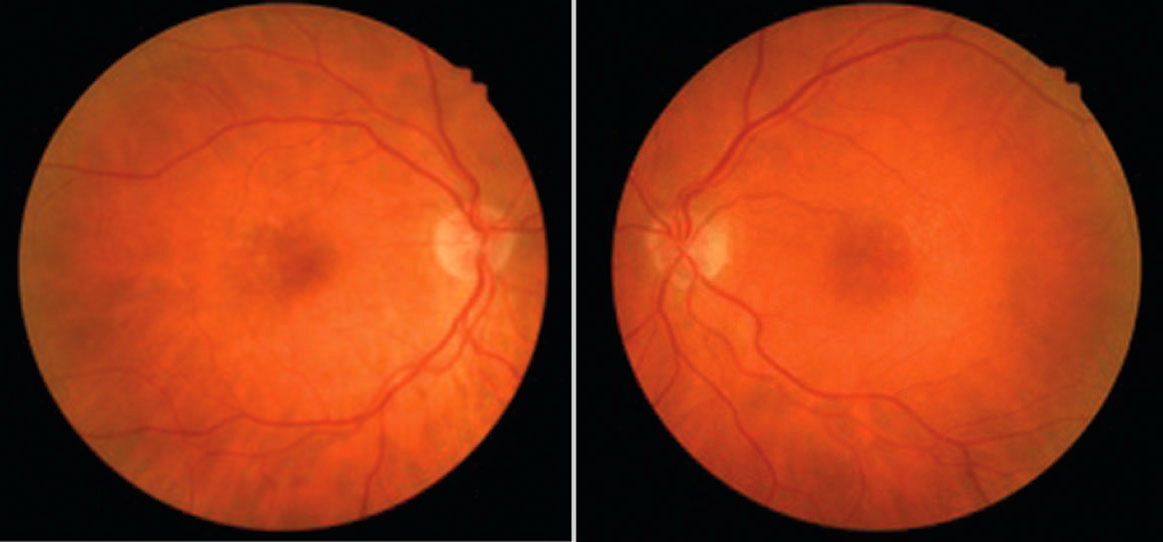 This study identified various biomarkers of progression from early to intermediate AMD. 
