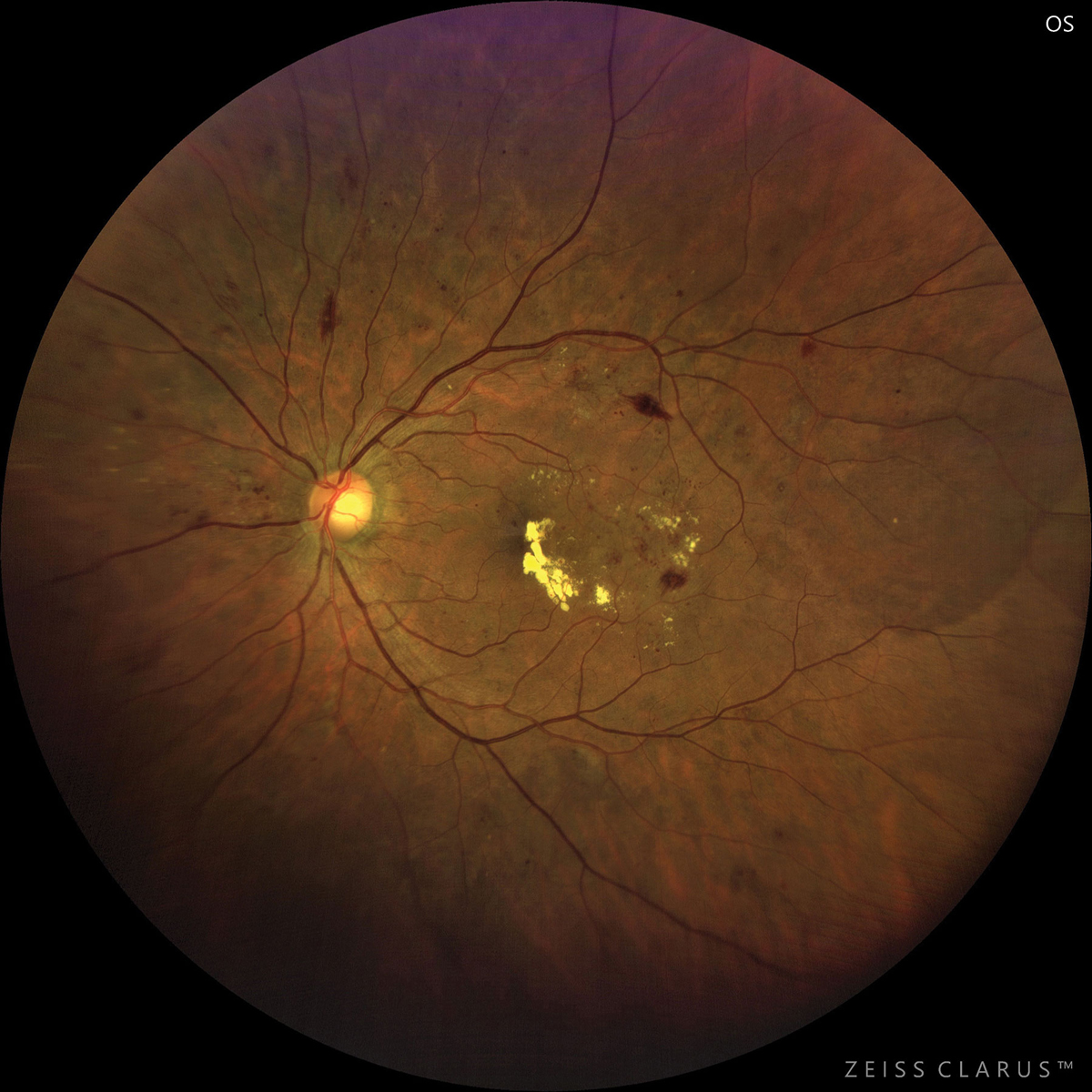 Diabetic patients with macular edema, such as this patient with CSME, may have worse anti-VEGF treatment outcomes than patients with better retinal parameters.