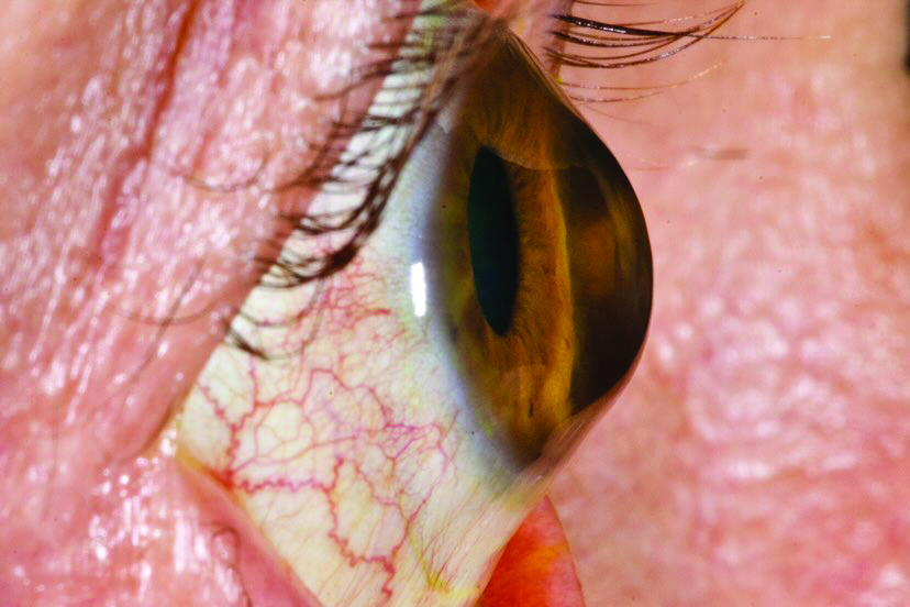 Patients who are family members of someone with keratoconus should be screened for the disease prior to undergoing refractive surgery, study suggests. 