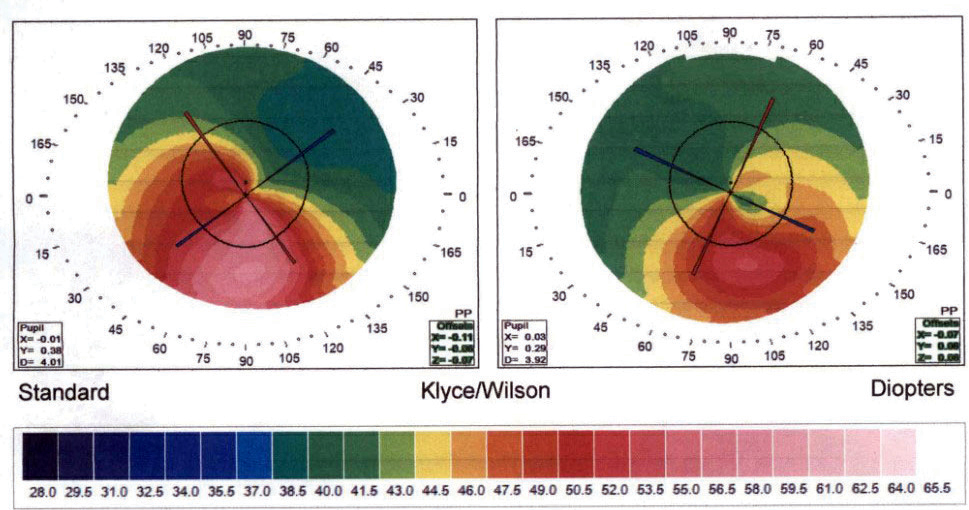 Keratoconus patients with fewer HOAs post-CXL had improved binocular performance.
