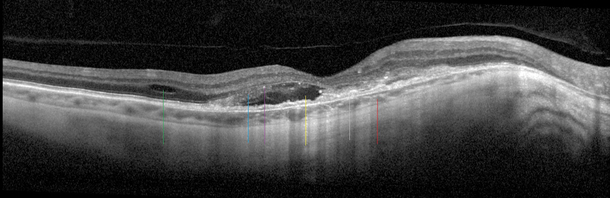 Using OCT-A regularly on patients with myopic CNV on anti-VEGF therapy can help monitor treatment response. 