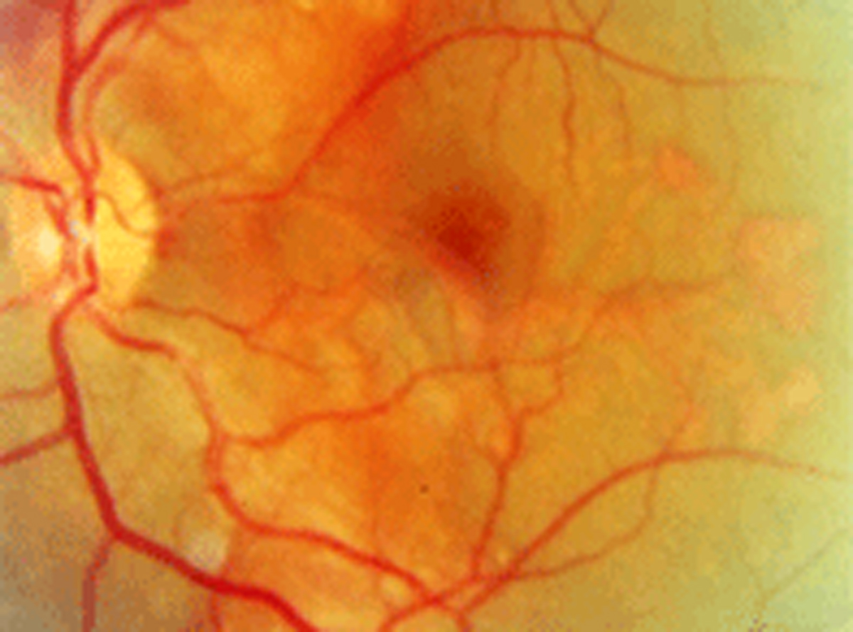 Beyond four months, anti-VEGF therapy may no longer be effective at slowing progression of AMD-related peripapillary CNV.