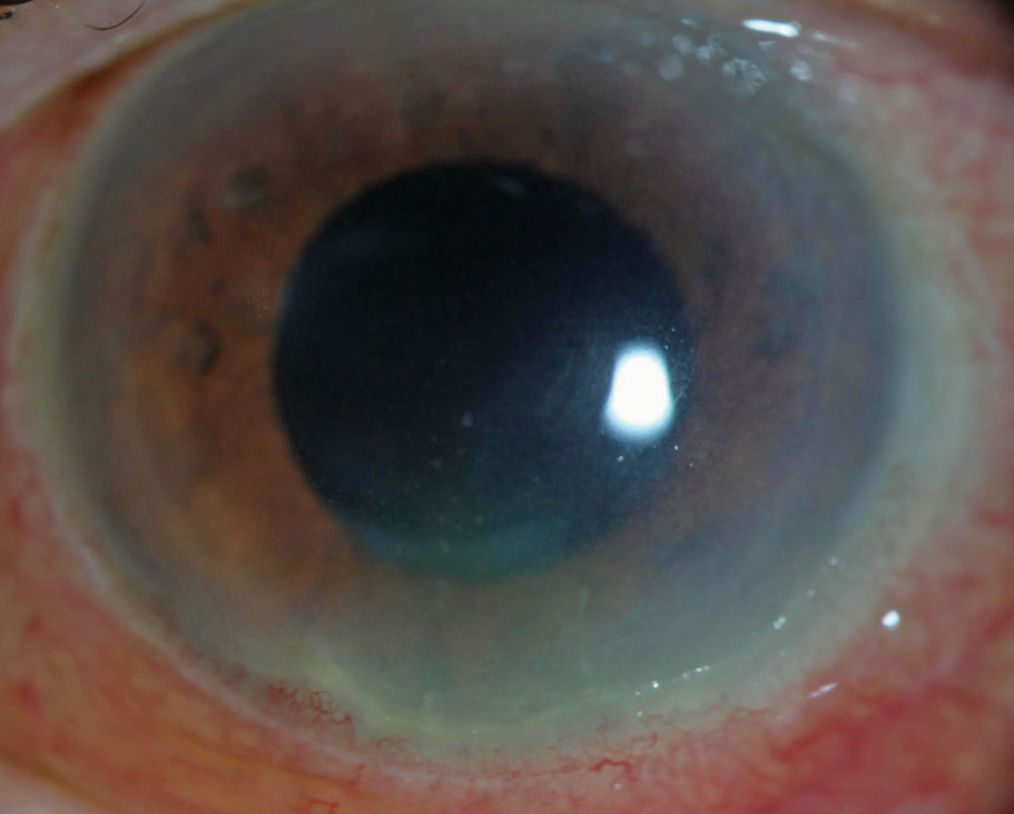 When treated early with immunomodulatory therapy, children with anterior uveitis may be able to avoid secondary complications down the road.