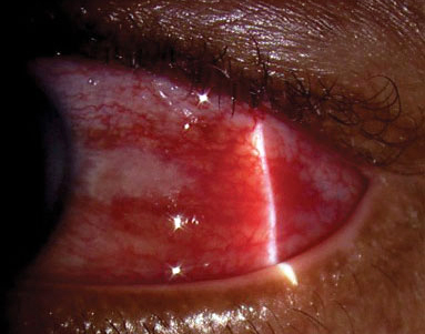 Worse outcomes among scleritis patients were observed in several at-risk populations in this study.