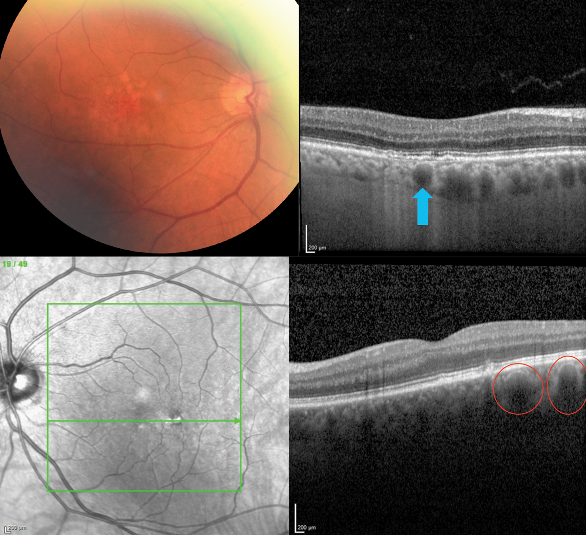 Choroidal vascularity index could have prognostic utility in AMD.