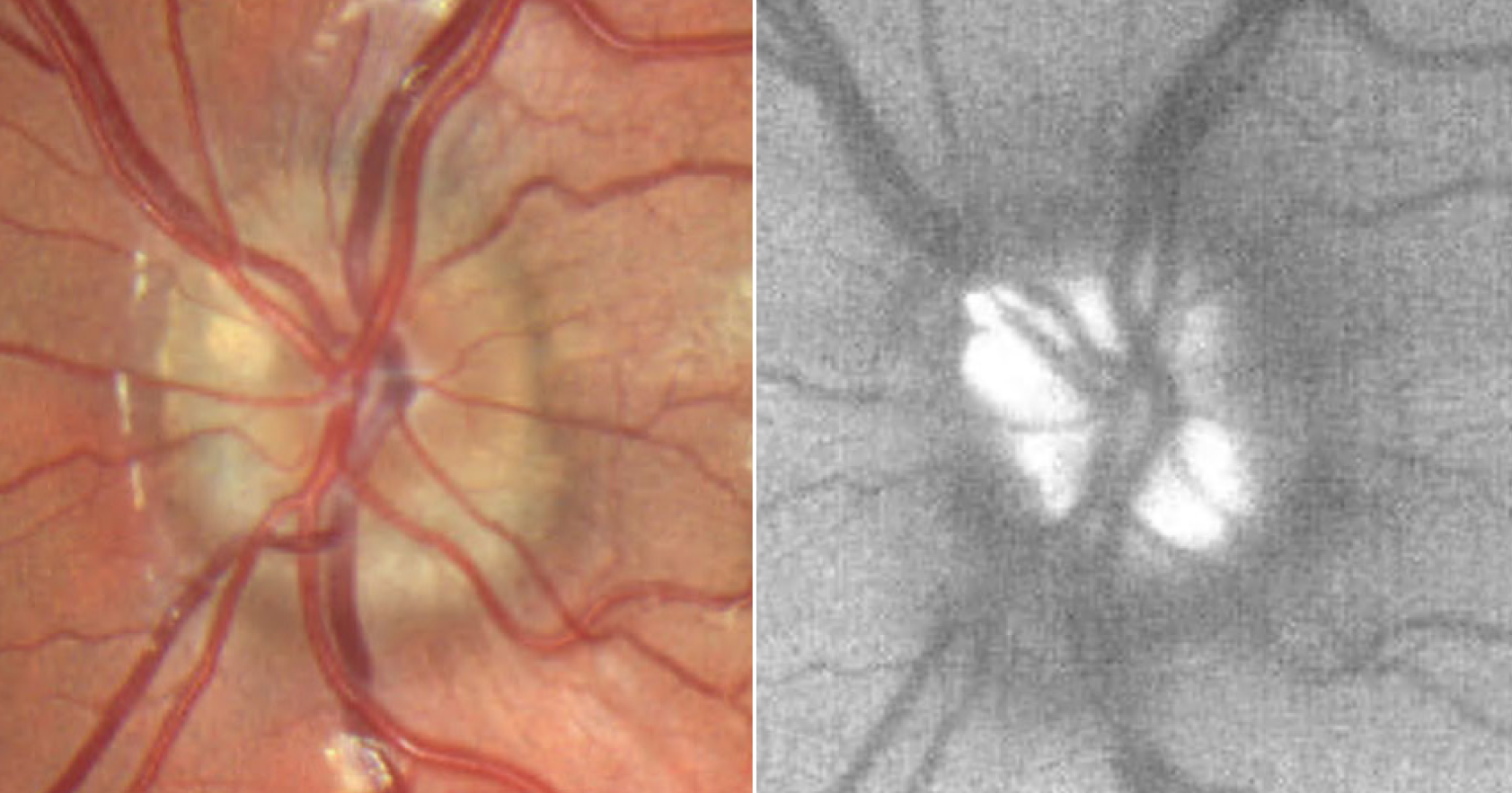 Optic disc drusen could signify a patient at risk for nonarteritic AION.