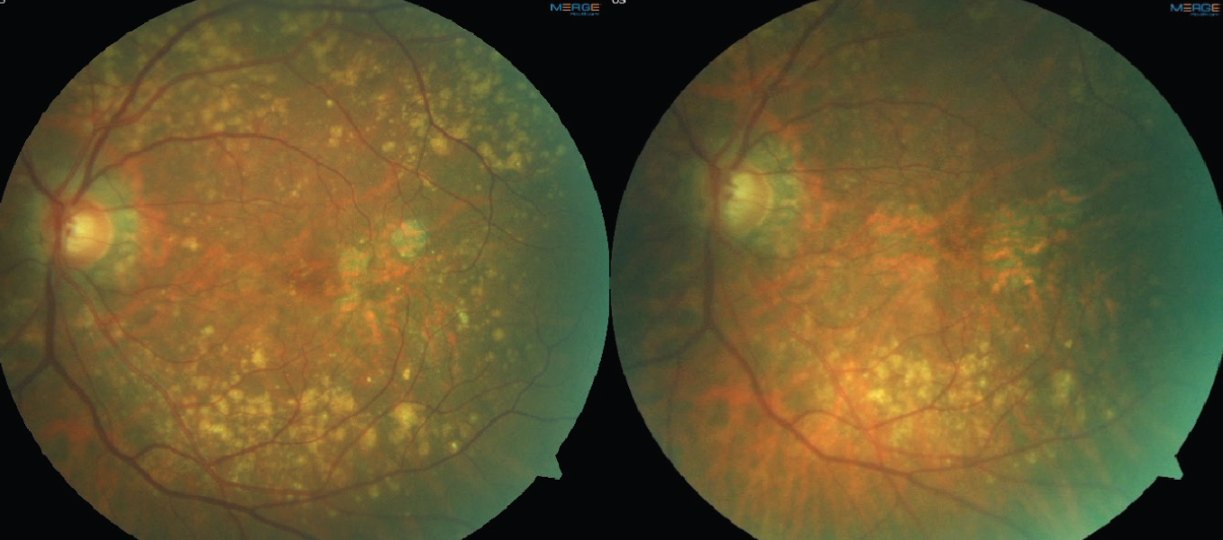 Fig. 2. Color fundus photos demonstrating drusen regression in a patient with multifocal GA lesions. The left image is baseline. The right image is four years later, showing a decrease in drusen volume and progression of GA lesions.