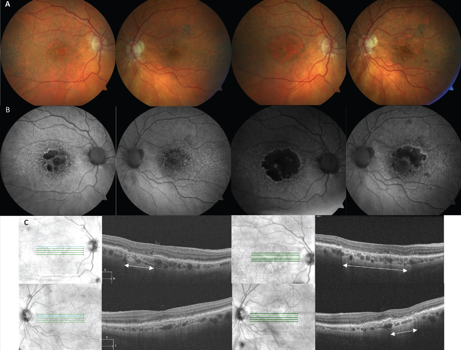 Fig. 4. (A) Color fundus photos of a 90-year-old Caucasian female with bilateral GA AMD. The images on the left are baseline and on the right are 29 months later. (B) FAF images on the left highlight hypoautofluorescence of multifocal lesions of GA in both eyes (OD>OS) that on the right side have expanded and coalesced over time. (C) SD-OCT image of the right eye (top left) shows an area of cRORA (white arrows) that expanded to a much wider lesion (top right). The left eye OCT at baseline (bottom left) did not have cRORA, which then developed after 29 months (bottom right). 