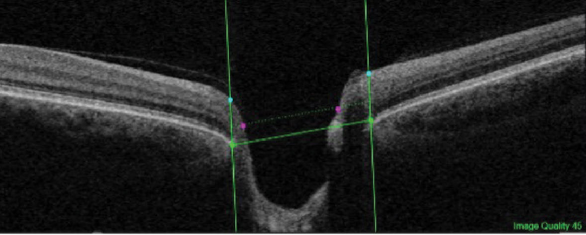 The BMO is identified by the horizontal green line (connecting the lateral edges of the structure) and the cup edge is identified by the purple dots. The cup edge is on a plane 120μm anterior to the BMO plane and extends laterally from the edges of the axons exiting the nerve.