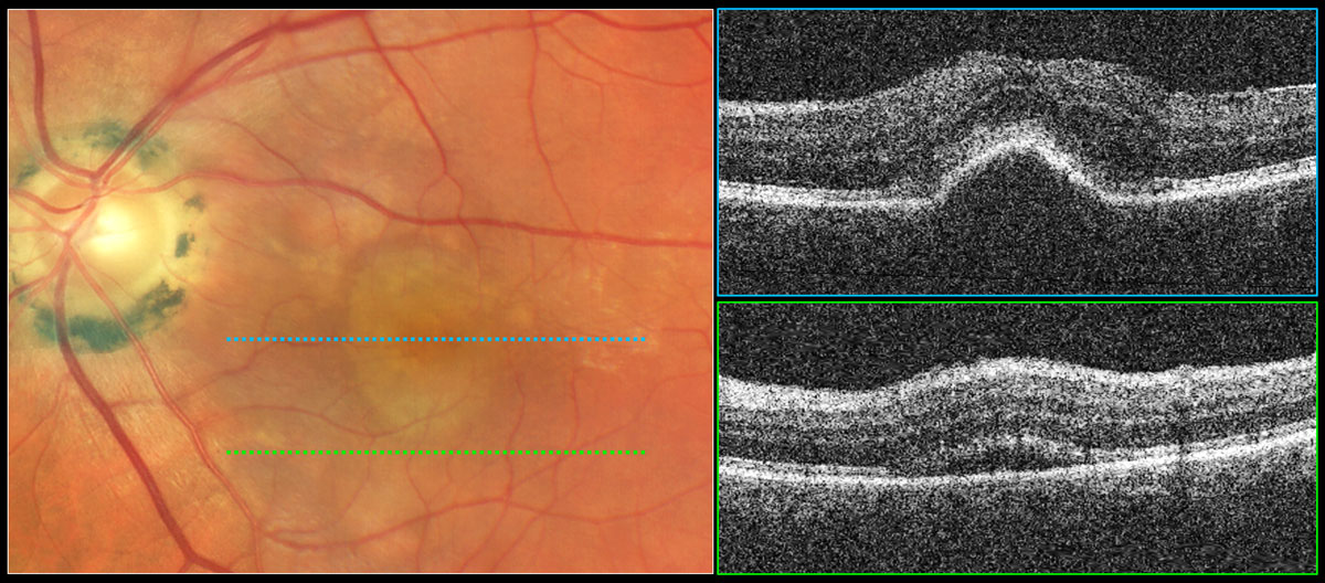 Fig. 4. Serous PED with subretinal fluid suggestive of exudative AMD. Color photography shows a well-demarcated, dome-shaped, yellowish elevation of the RPE in the central macula. The top OCT raster scan reveals elevation of the RPE with a rather smooth surface and dark internal reflectivity consistent with a serous PED. The bottom OCT raster scan reveals subretinal fluid suggestive of exudation from a neovascular source requiring treatment.