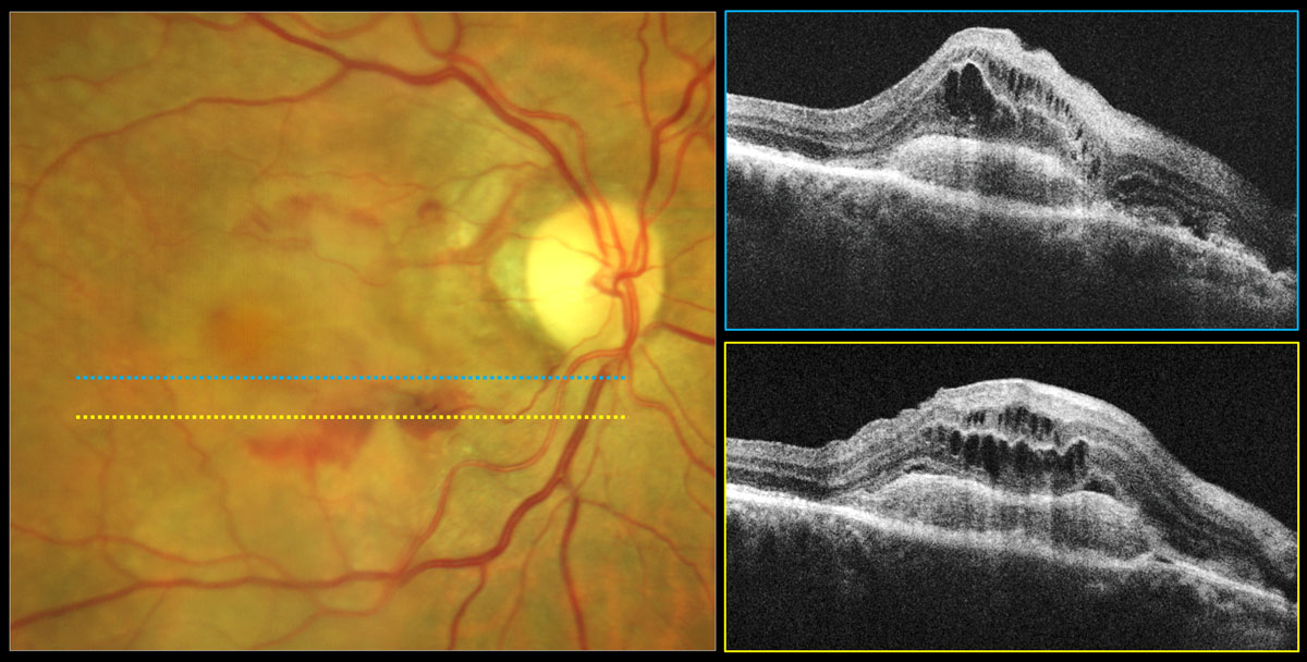 Fig. 6. Type 2 neovascular exudative AMD. Color photo shows central gray-green subretinal thickening with surrounding subretinal hemorrhage. OCT reveals hyperreflective subretinal mass corresponding to a type 2 neovascular membrane with overlying intraretinal cystic edema.