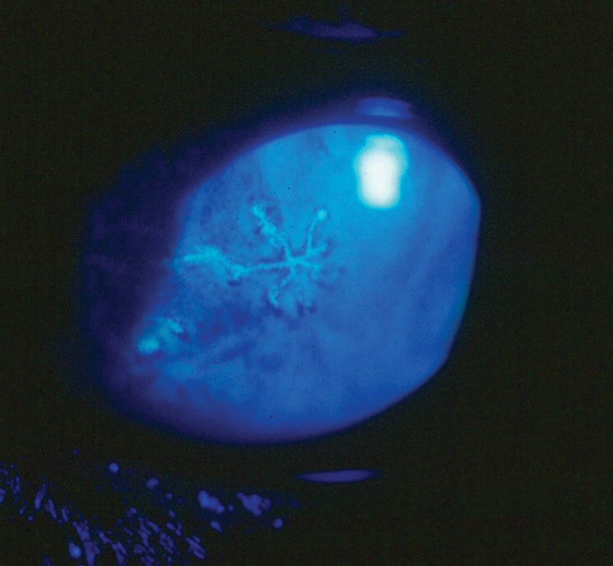 The herpes simplex dendrite is a hallmark finding in HSV keratitis.