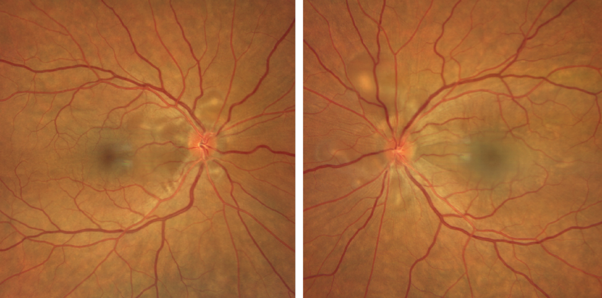 Figs. 1 and 2. Clarus fundus photography of the right eye (left) and left eye (right).