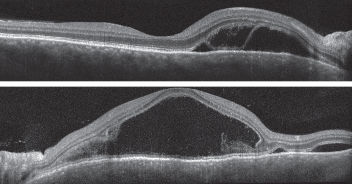 Figs. 3 and 4. Heidelberg spectral-domain OCT of the right eye (top) and left eye (bottom). 