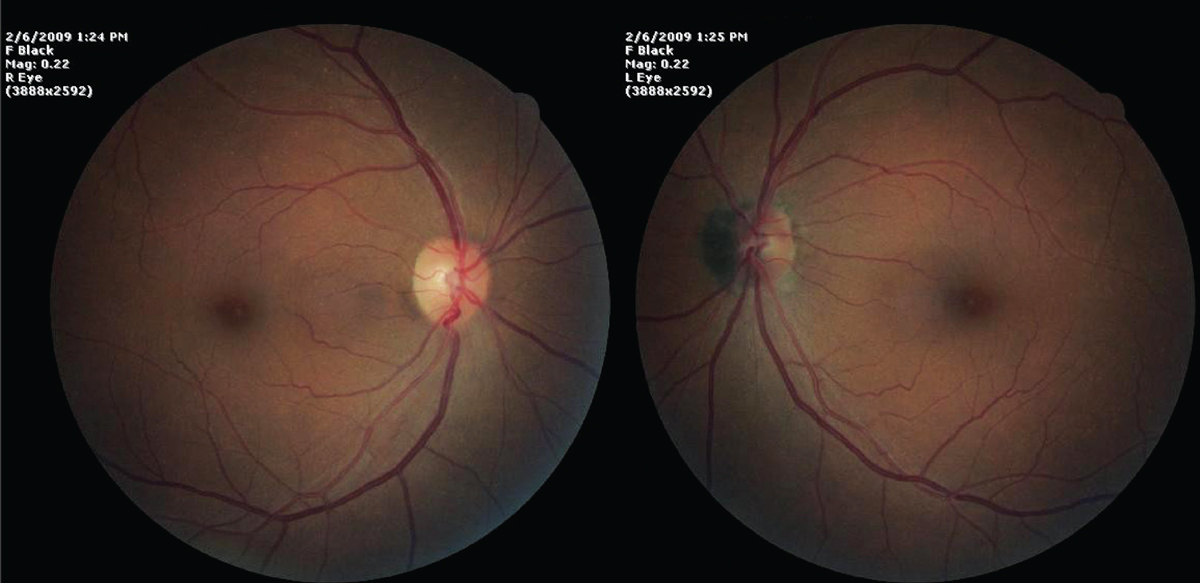 Fundus exam findings in our patient. What do these images suggest to you?
