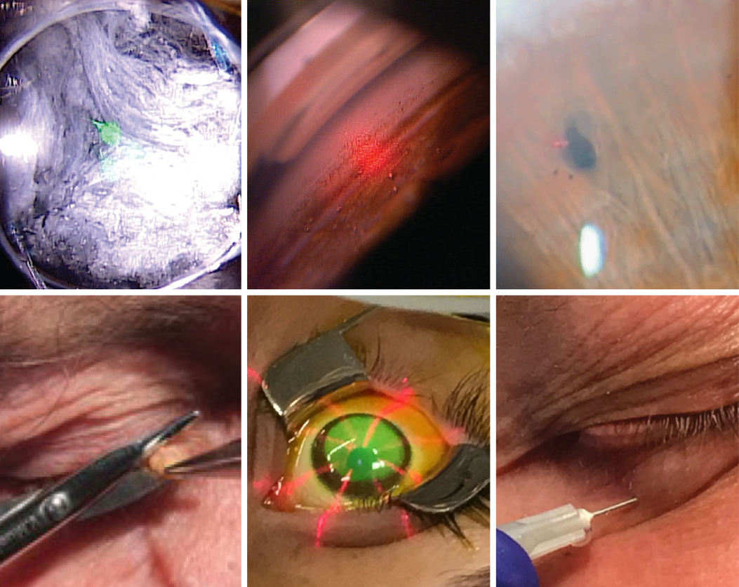 Colorado’s new law adds these services to its optometric scope: (clockwise from upper left) capsulotomy, SLT, peripheral iridotomy, intralesional injection, collagen crosslinking, lesion incision/excision.