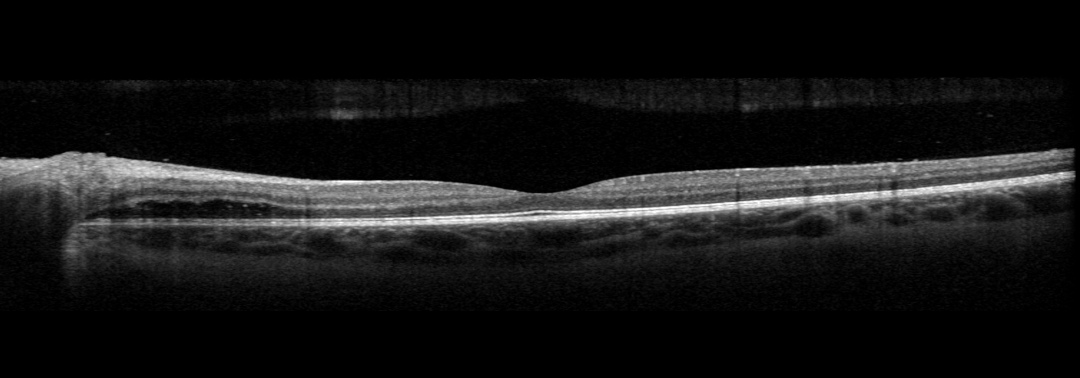 Figure 4. OCT of the left eye: no cystoid macular, mild subretinal fluid accumulating underneath the retina arising from the optic nerve head. 