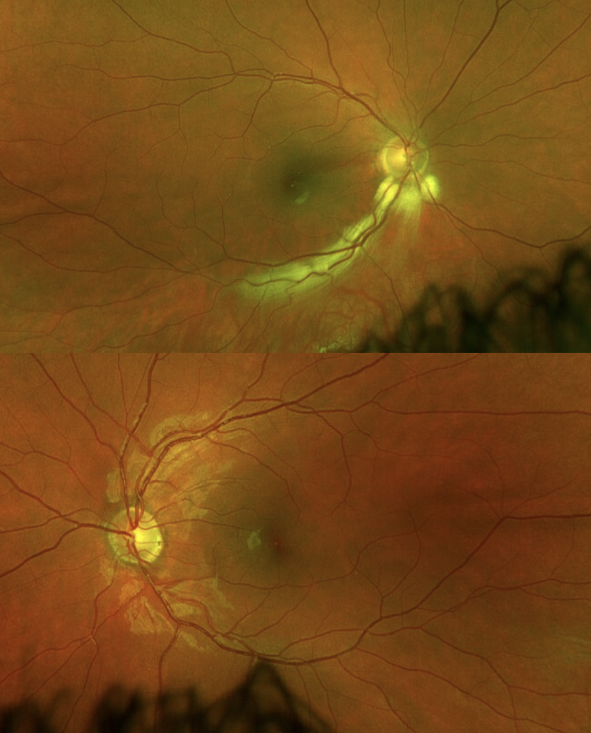 Figure 5. Four-month follow-up: resolution of optic nerve head and macular edema of both the right eye and left eye. 