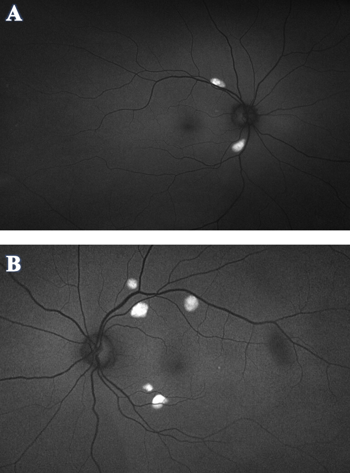 Figure 3. Optos fundus autofluorescence (FAF) of OD (A) and OS (B) demonstrated hyper-autofluorescence corresponding to the orange-yellow lesions seen in the fundus photos. No hypo-autofluorescence was appreciated in either eye. 
