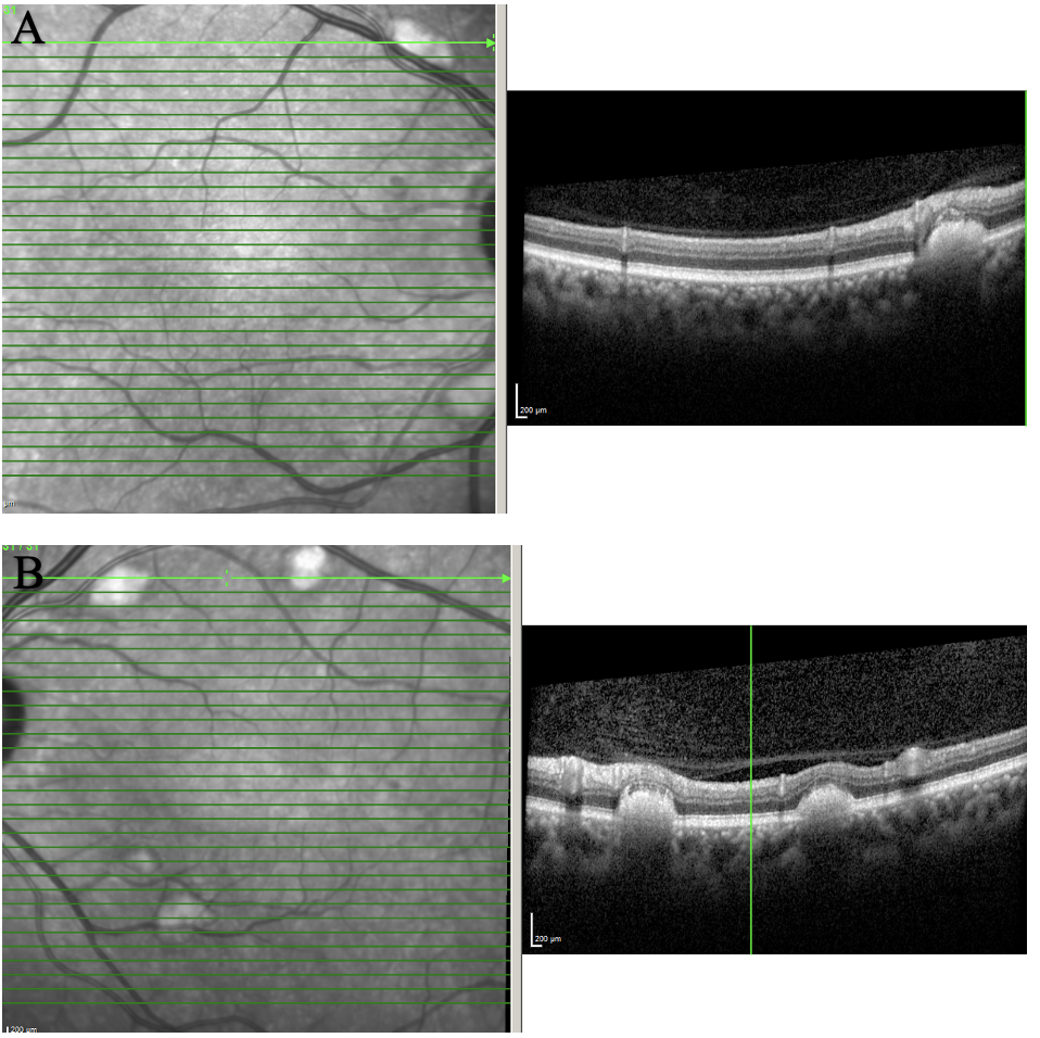Figure 2. OCT of the posterior pole of OD (A) and OS (B) showing scattered subretinal deposits along the arcades. The lesions were elevated and caused outer retinal layer disruption and elevation. 