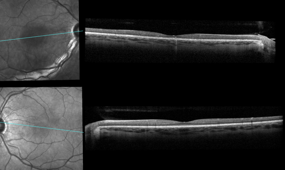 Figure 6. Four-month follow-up: The macular OCT of the right eye (top) shows resolution in macular edema and serous macular detachment. The macular OCT of the left eye (bottom) shows resolution of the subretinal fluid accumulation. Directly comparing the right to the left eye, you can observe retinal thinning of the right eye (also see Figure 7) with a flatter foveal contour leading to decreased visual acuity in the patient. 