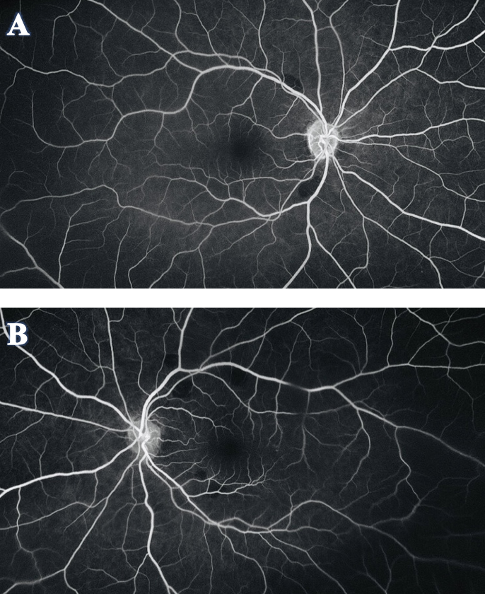 Figure 4. FA of OD (A) and OS (B) showed the orange-yellow fundus lesions corresponded to areas of hypo-fluorescence or a blockage of fluorescein. There was no leakage or staining in early or late phase, and normal retinal perfusion was observed in both eyes.