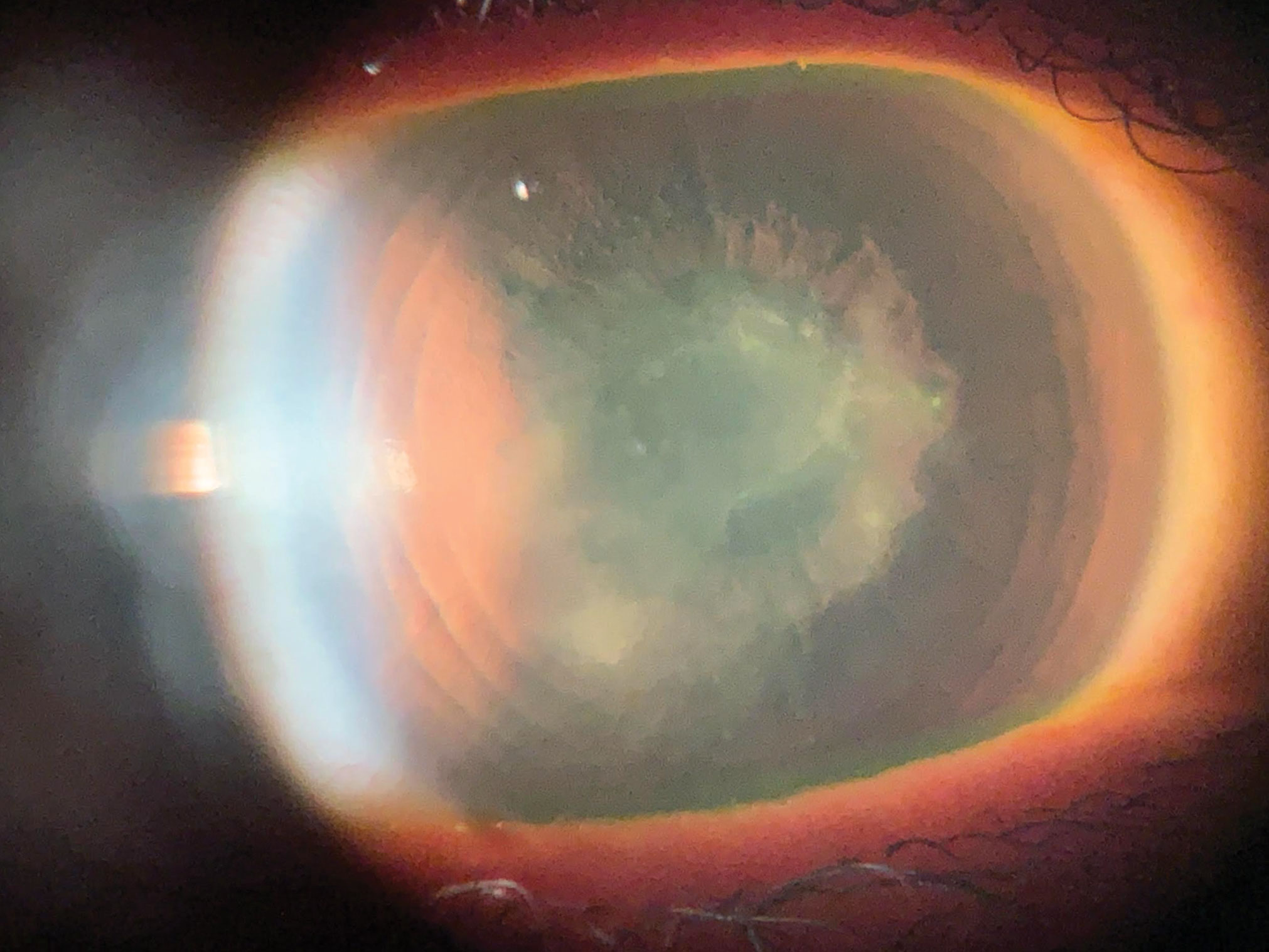 A corneal scar from HSVK with a persistent epithelial defect after a corneal erosion.