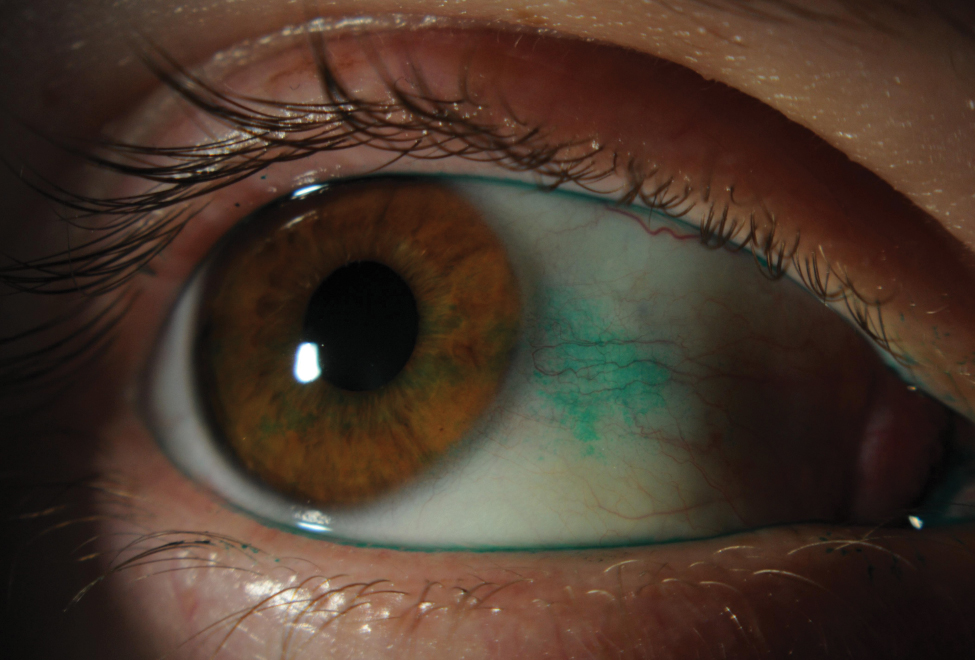 Slit lamp photo depicting lissamine green staining on conjunctiva from dry eye.